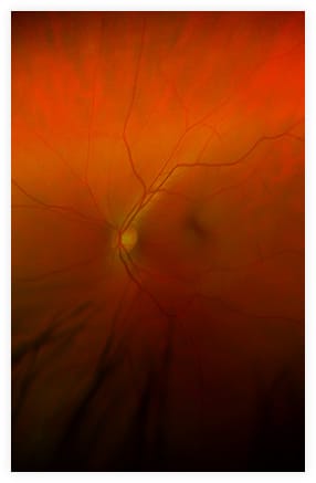 Retinal Care